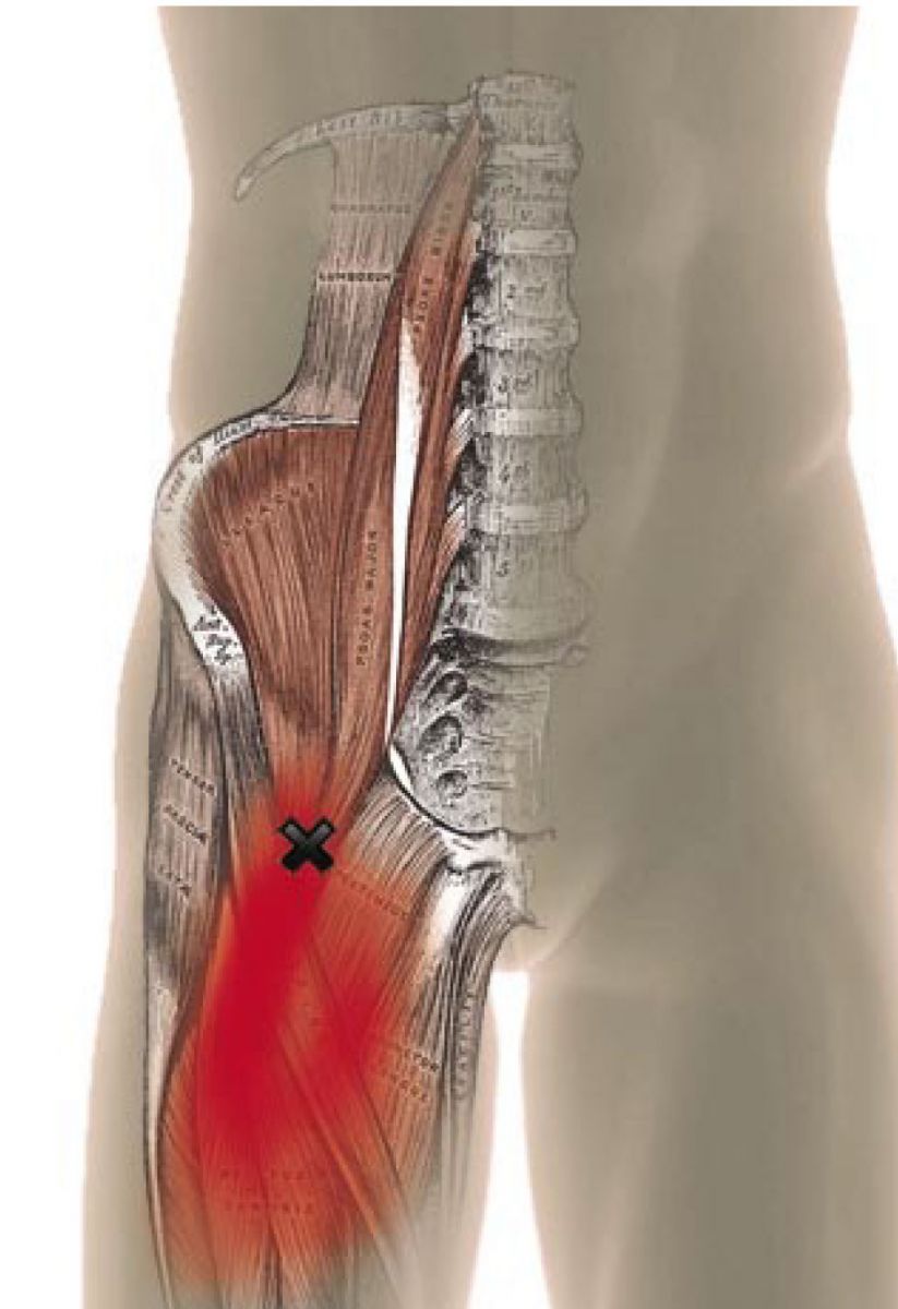 image is of a psoas...